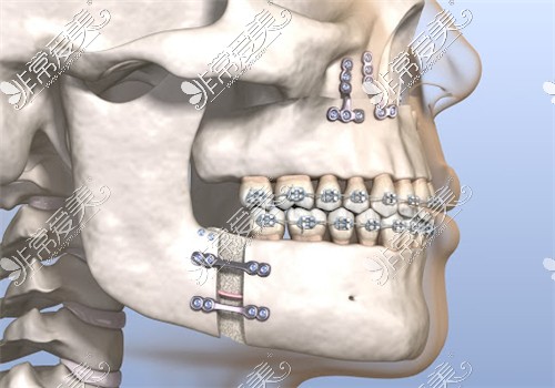 正颌手术动画图