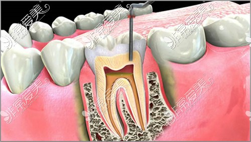 根管治疗是可以保留牙根的毕竟还是真牙,但是拔牙做种植牙或连桥冠
