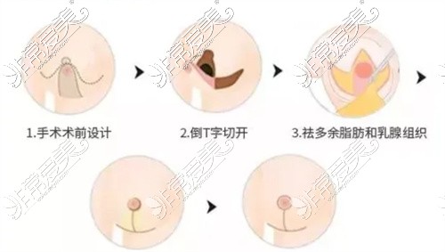 巨乳缩小示意图