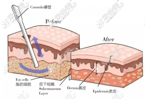 威塑二代吸脂