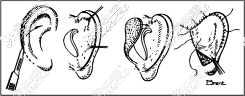耳再造手术示意图