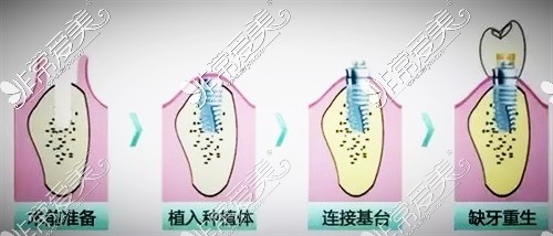 新疆阿克苏白钻石口腔种植牙示意图