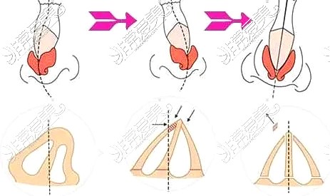 揭秘:整鼻子最佳年龄是什么时候?必须过了18岁才能隆鼻吗!