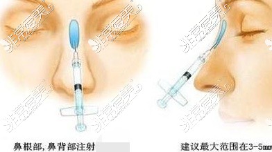 注射隆鼻示意图