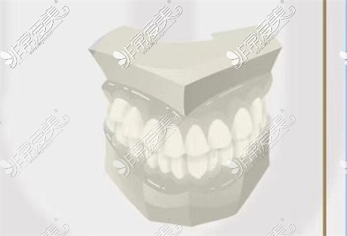 石膏牙模图