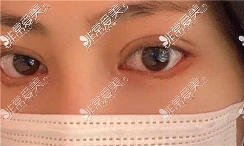 芜湖名姝医疗美容医院双眼皮+开眼角+去皮+去脂