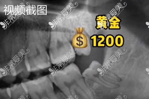 到了這個(gè)段位，這些情況的智齒需要拔除！