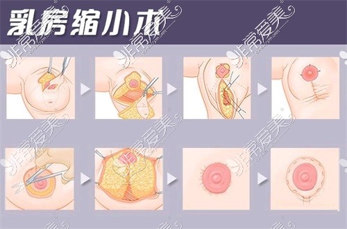 新疆王共礼整形医院巨乳缩小术示意图