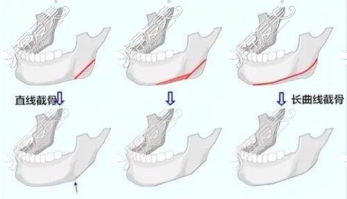 下颌角长曲线截骨图示