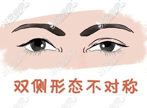 双眼皮失败卡通图