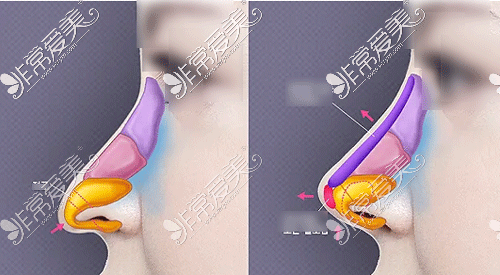 隆鼻手术各细节展示