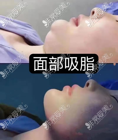 西安现代妇产医院医疗美容科面部吸脂