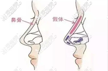 假体隆鼻示意图图