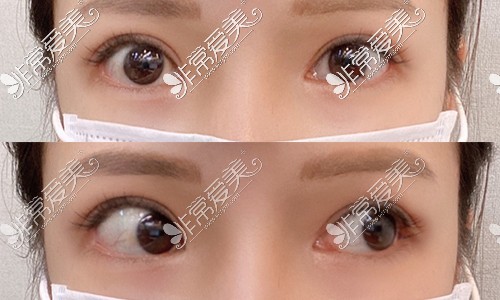 韩国JUST整形外科上眼皮脂肪移植+提肌手术术后3个月