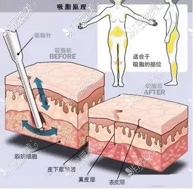 福州吸脂塑形功课解析,打包整理哪家抽脂做得好及擅长医生!