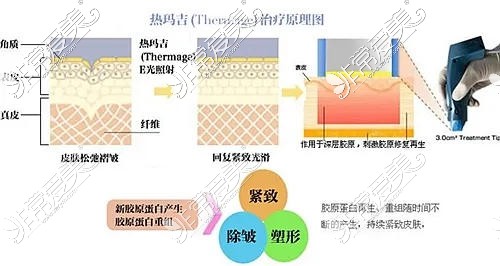 贵阳去颈纹哪家医院做得好？激光注射热玛吉去颈纹哪个好