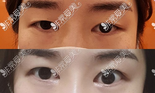 韩国JUST整形外科眼提肌修复手术前