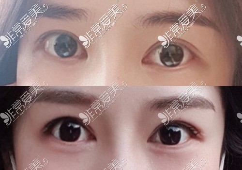 韩国JUST整形外科眼提肌修复手术后3个月