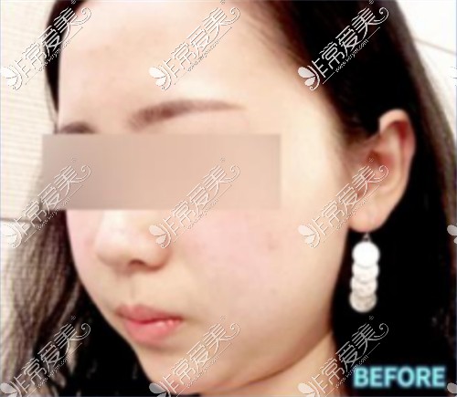 韩国宝士丽医院面部吸脂术前图