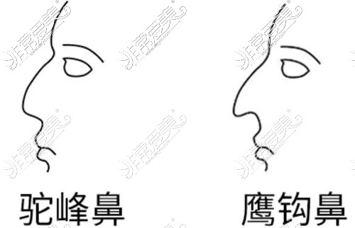驼峰鼻形态展示图