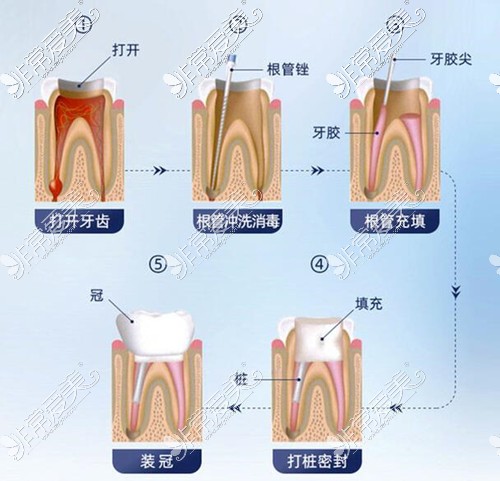 根管治疗大概步骤和流程