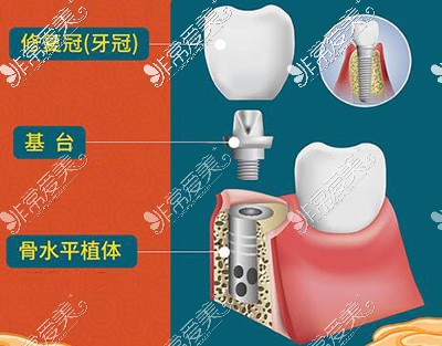 种植牙的组成部分