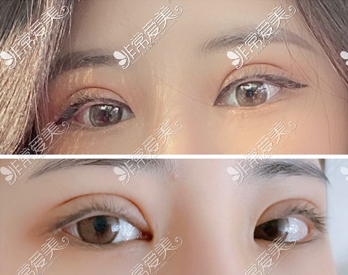 眼睑肌修复手术术前图