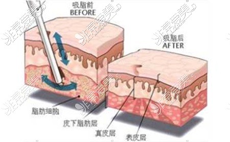 新疆昌吉自体脂肪填充示意图