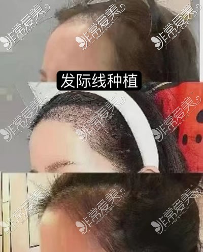 西安现代妇产医院美容科发际线种植