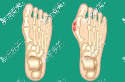 天生大脚骨可以矫正吗？别不信，大脚骨真的能矫正过来