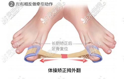 保守治療拇外翻示意圖