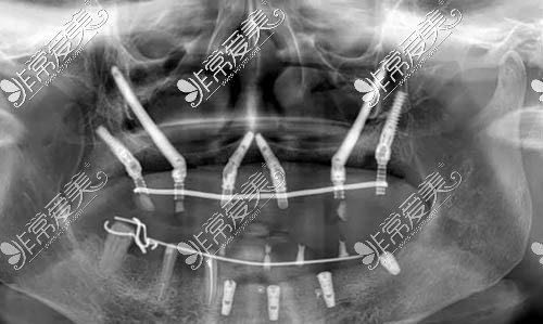 全口种植术后ct照
