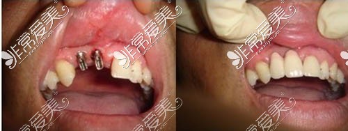 韶关种植牙一颗多少钱？国产和进口种植牙的价格这里都有