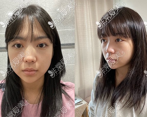 韩国WAVE整形医院鼻整形+鼻功能手术前