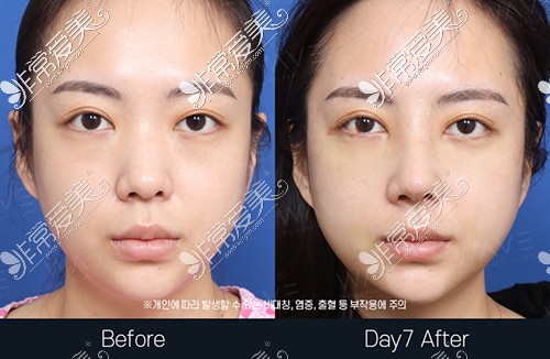 韩国WAVE整形医院鼻整形+鼻功能术后七天