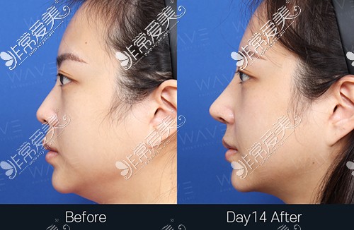 韩国WAVE整形医院鼻整形+鼻功能术后十四天