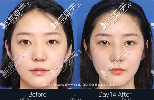 韩国WAVE医院鼻子修复手术前后对比图片