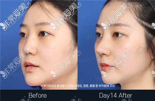 韩国WAVE整形外科鼻子修复手术前后图片