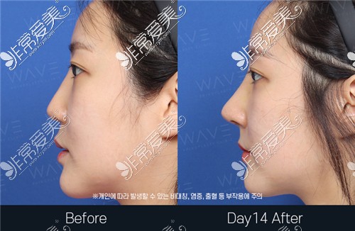 韩国WAVE医院鼻子修复手术前后侧面对比图片