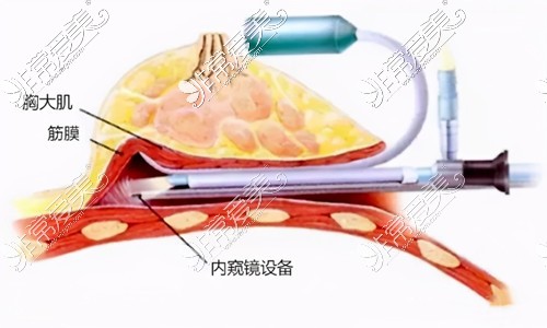 内窥镜隆胸示意图