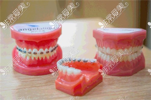 各类牙齿矫正器展示图