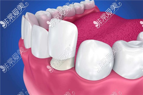 牙齿贴面示意图