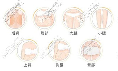 哪些部位要做吸脂改善