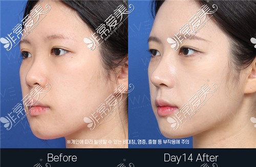 韩国WAVE整形外科鼻综合整形前后对比图