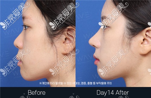 韩国WAVE整形外科鼻综合整形前后侧脸对比图