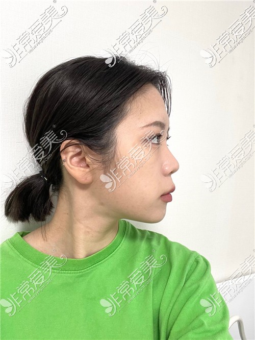 鼻综合整形术前侧脸图