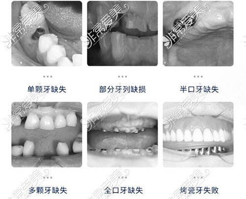 牙齒缺失示意圖