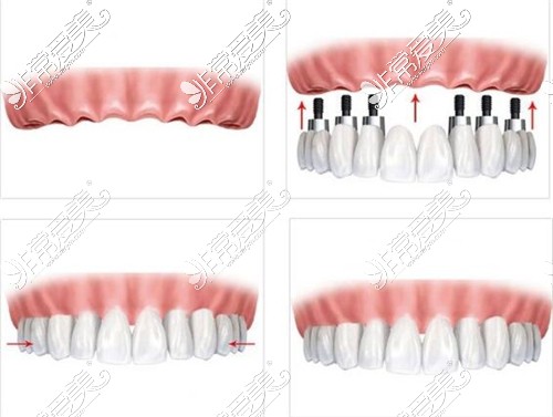 多颗种植牙示意图