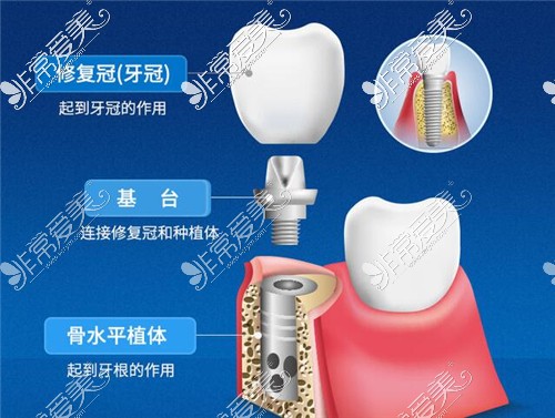 种植牙结构示意图