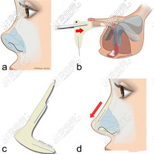 隆鼻手术过程展示